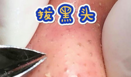清理黑头粉刺视频,跟我学视频清洁术